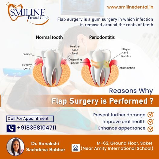 Flap Surgery