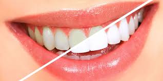 Artificial Teeth