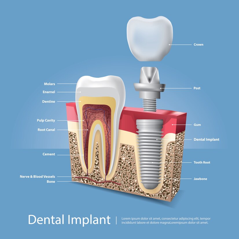 Best Dental Implant Clinic